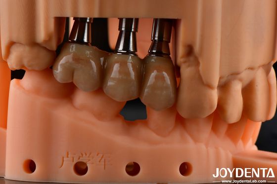 Alta resistenza flessibile multilivello Soluzione dentale a zirconia completa Restaurazioni a arco completo