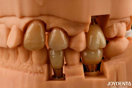 Corona e ponte personalizzabili per l'impianto: un aspetto naturale con risultati duraturi