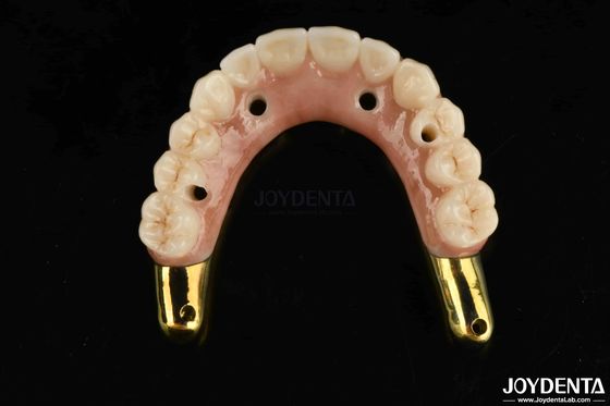 Ponte ibrida in zirconia resistente all'usura con denti e gengive naturali compatibili