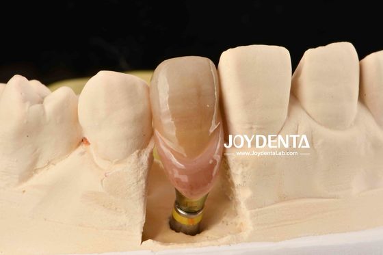 0° Angolazione Abutamenti dentali finiti 1,5 mm Filtro di filo Superficie lucidata