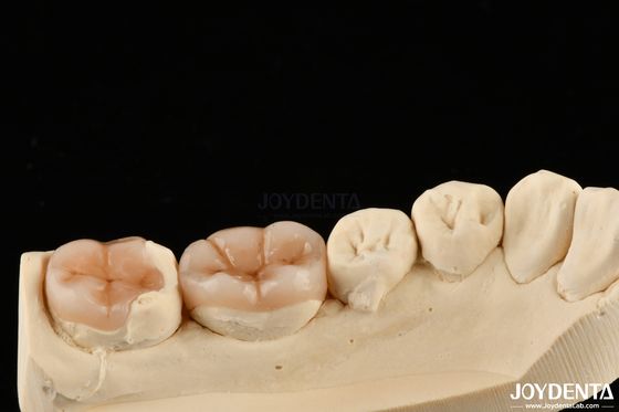 Ricostituzione dentale in inlay composta dall'aspetto naturale