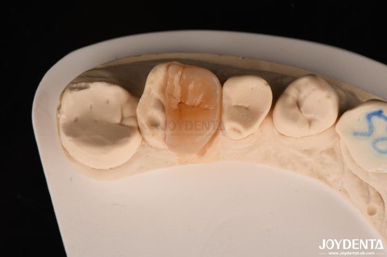 Inchiostro in zirconia con cementazione adesiva per la restaurazione dei denti danneggiati