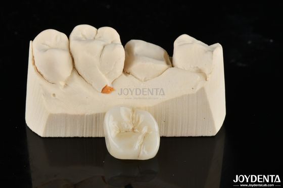 Infissi e rivestimenti in zirconia realizzati su misura per un'idoneità ed estetica senza pari