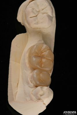 Infissi dentistici Emax e infissi dentistici resistenti alle fratture 1,5 mm bassa traslucidità