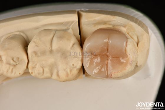 Facile da pulire Infissi e infissi Emax Ipoallergenici Restaurazioni dentali biocompatibili