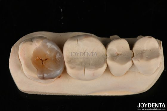 Infissi e infissi dentistici personalizzati per la restaurazione dei denti