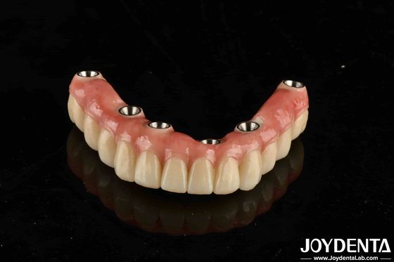 Dental Titanium Malo Implant Bridge combinando tecniche tradizionali e moderne