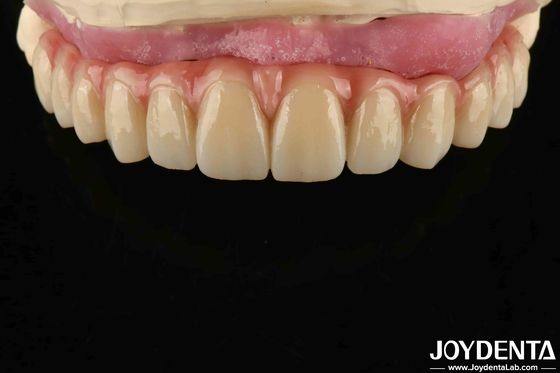 Confortevole Indossare Titanio Malong Hybrid Bridge Dental Disegno regolabile Peso leggero