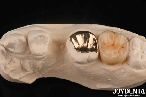 Corona dentale in oro resistente all'usura con 60K metallico
