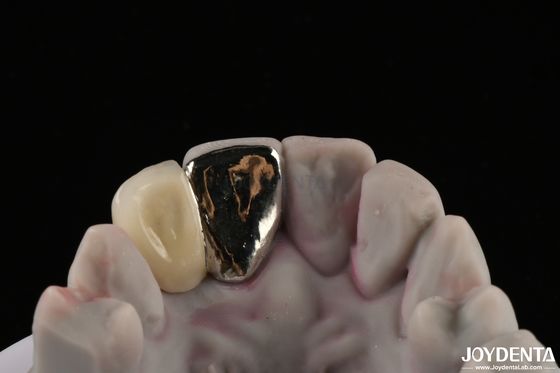 Metallico Dental Maryland Bridge Buona funzione di masticazione per un rimedio duraturo