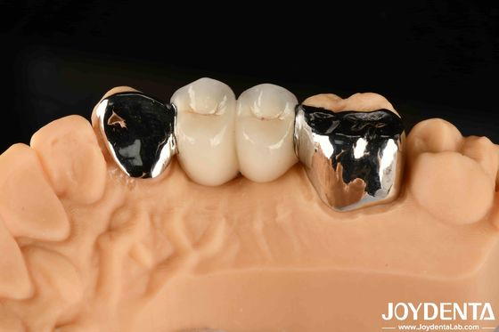Metallico Dental Maryland Bonded Bridge Buono rimedio per la riparazione clinica orale