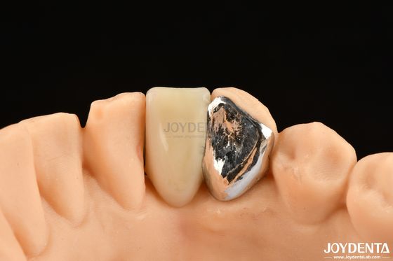 Parità ideale di legame clinico Maryland Dental per il lavoro di riparazione clinica orale