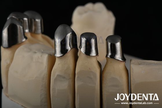 Accoppiamenti dentali in acciaio, accoppiamenti dentali parziali di precisione rimovibili