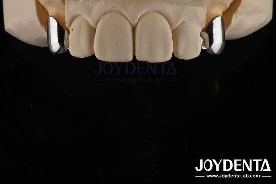 Protesi rimovibile di precisione Impianti dentali