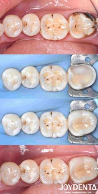 Ripristino di inchiostro di porcellana dentale personalizzabile per la riparazione dei denti perfettamente adattati