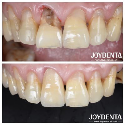 Dente di superficie liscia Corona di zirconia per restauri posteriori e anteriori