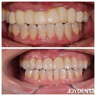Ponte di zirconia dentale a più strati di colore naturale per un'esperienza ottimale del paziente
