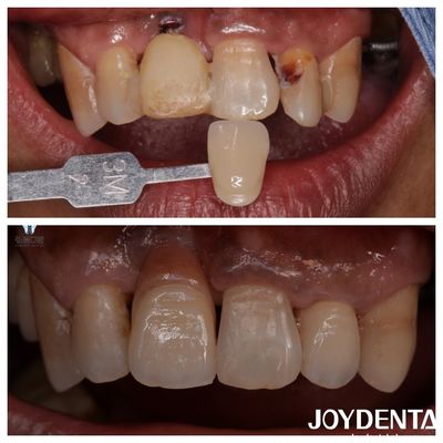 Dental Zirconia Veneers personalizzati Colore naturale Restaurazioni realistiche Aspetto dei denti