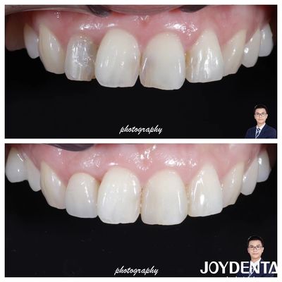 Estetica Traslucidità Corona di zirconia naturale Alta resistenza alle fratture