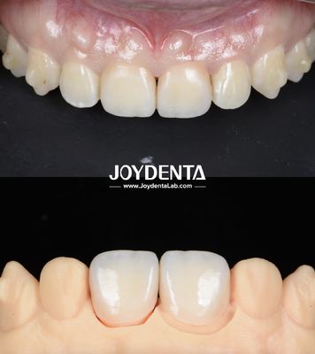 Ponte dentali di zirconia a superficie liscia e leggera per restauri a supporto di impianti