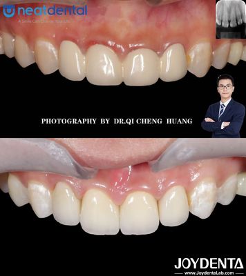 Corone di zirconia a più strati di alta traslucidità per denti anteriori e posteriori resistenti alle crepe