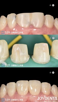 Denti perfettamente adattati Coroane dentali circonia con sistemi CAD CAM per la produzione di precisione