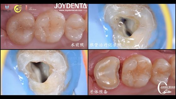 Durabile Infisso di ceramica dentale dall'aspetto naturale Precise Fit Alta compatibilità