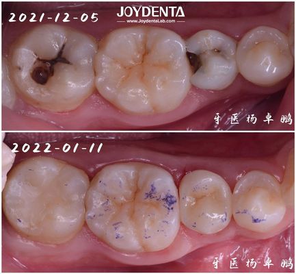 Restituzione dentale in incasso ad alta durata per denti danneggiati Disponibili in varie dimensioni