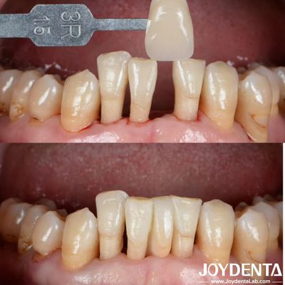 Forma naturale Ceramica Maryland Ponte legata Restaurazioni dentali Eccellente estetica