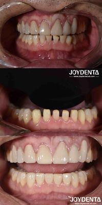 Forma Naturale Dentistica Cosmetica Porcellane, Dentistica Cosmetica Porcellane