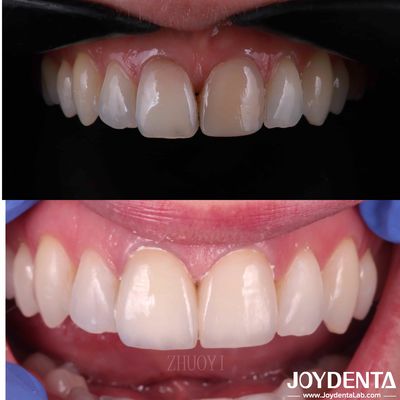 Finiture dentali a superficie liscia per denti storti, finiture di porcellana cosmetica personalizzate