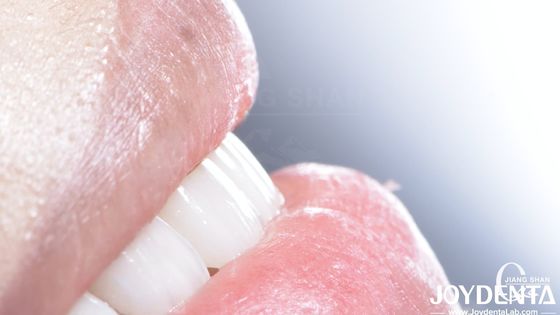 Durabilità della finitura composita dentale Buona biocompatibilità Non caduta finiture di porcellana