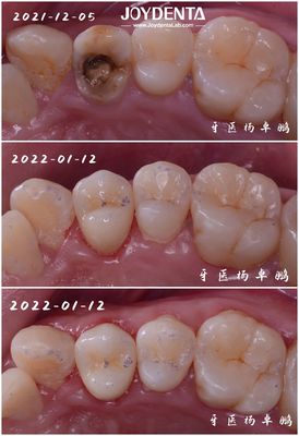 Infissi di porcellana dentale adatta per restaurare i denti danneggiati per adulti e bambini