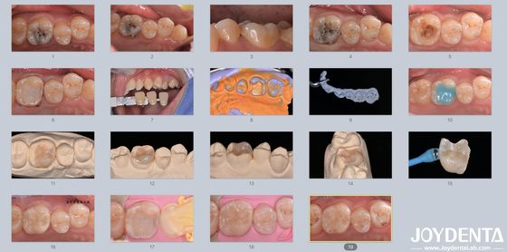 Adulti Bambini Infissi dentali in ceramica di porcellana per denti danneggiati