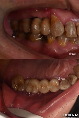 Implantazione dentale a superficie ruvida per materiale in titanio a livello osseo sottocrestato