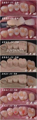 Procedura dentale in legno di porcellana senza cuciture Forma personalizzabile per la riparazione dei denti