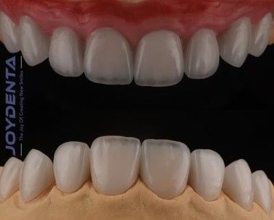 Rivestimenti di porcellana cosmetica ad alta traslucidità.