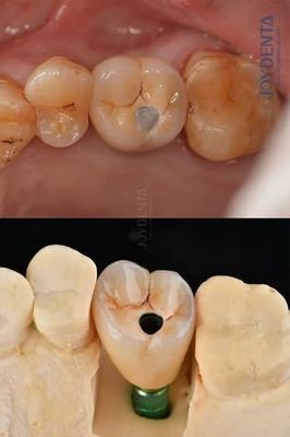 Impianti dentali in titanio a arco pieno Piattaforma protesica da 4,1 mm per una durata eccezionale