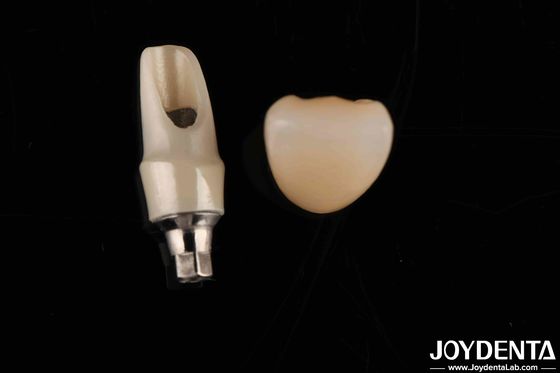 Circonia Abutments e barre personalizzate Restaurazioni dentali per l'anatomia del singolo paziente