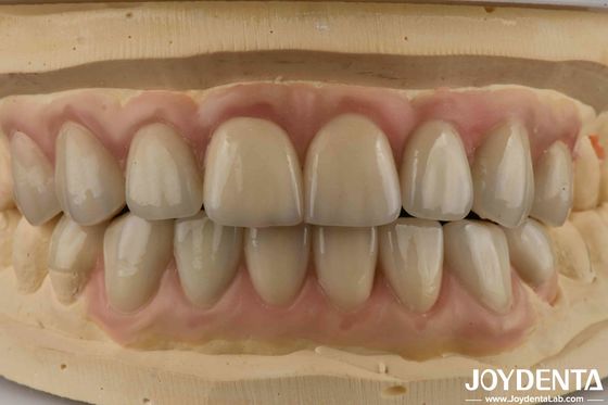 Alta traslucidità Emax Cosmetica Odontoiatria Finiture Alta estetica Ultra sottile