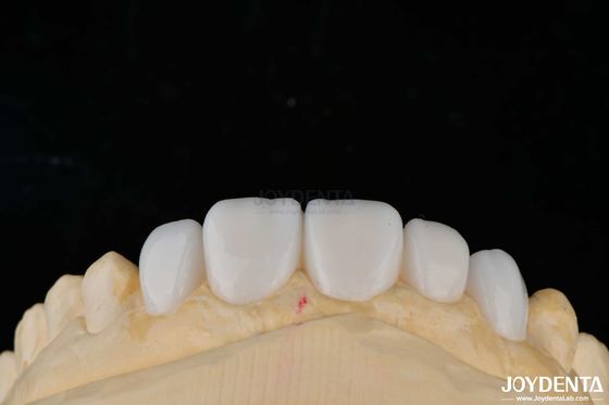 Materiale di porcellana di personalizzazione Emax veneers dentali per un'alta estetica di legame