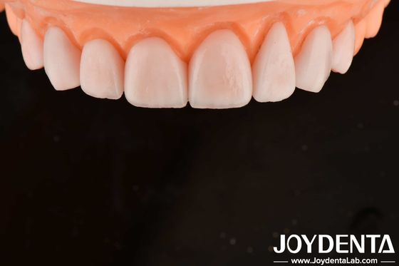 Prodotto su misura IPS Porcellana Emax Rivestimenti dentali Resistenza ai frantumi