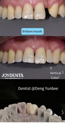 Denti posteriori di Maryland Bridge legati a resina per il filo interdentale da spazzolatura regolare