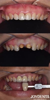 Biologicamente orientata tecnica di preparazione Verticale dentale Preparazione minimamente invasiva