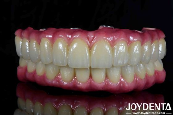 Ponte ibrido di titanio leggero per la restaurazione dentale
