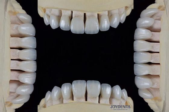 Finitura feldspatica ultra sottile spessore 0,3-0,5 mm resistenza alle macchie elevata adatta in modo preciso