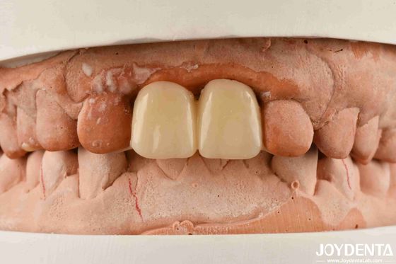 Polymethyl methacrylate di PMMA a più strati per restauri dentali