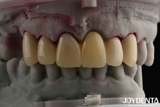 CAD CAM Processing Dental PMMA Material Multilayer Design per le transizioni naturali di ombra
