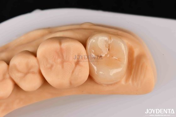 Alta resistenza Emax Inlay Onlay A2 colore duraturo per il ripristino dei denti danneggiati