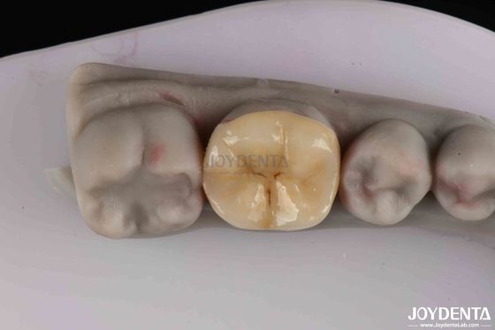 Preparazione minima per il ripristino dei denti danneggiati